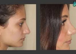 Rhinoplasty Beverly Hills