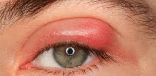 Arpacik Nasil Gecer Skin Care Pimples Natural Pink Eye Remedy Natural Headache Remedies