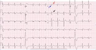 Type 1 Brugada Syndrome Jetem
