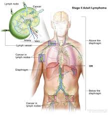 How to examine your lymph nodes. Hodgkin Lymphoma Vanderbilt Ingram Cancer Center