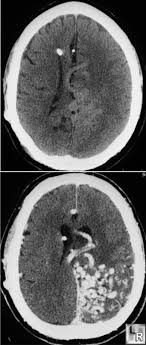 Unenhanced And Enhanced Axial Cts Of Brain Shows A Large Serpiginous Avm Adjacent To The Tentorium Radiology Imaging Radiology Interventional Radiology
