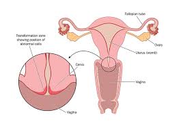 Warning signs of endometrial cancer. Cervical Cancer And Uterine Body Cancer What Is The Difference