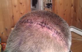 How to remove surgical staples after surgery (nursing): Surgical Staple Wikipedia