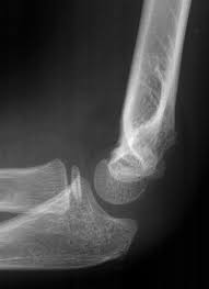 Image result for Elbow XRay
