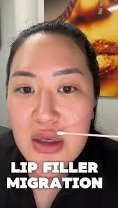 Chicago LIPS•FILLER•BOTOX•PRF