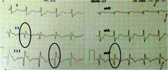 Elevasi segmen st, depresi segmen st, gelombang t memuncak, dan gelombang t terbalik; Diagnosis Sindrom Koroner Akut Alomedika