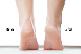 Wearing improper footwear like high heels or itching clothing like wool, as well being. How To Easily Get Rid Of The Dry Skin At The Bottom Of Your Feet Grandma S Things