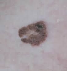 Manchas Marrones Y Rugosas Por El Cuerpo Doctora Lorea Bagazgoitia