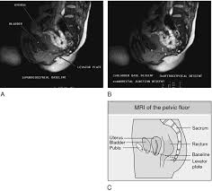 Anthropoid Pelvis Definition Of Anthropoid Pelvis By Medical Dictionary