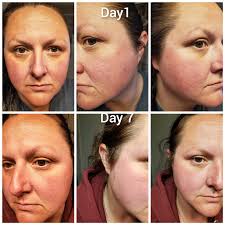 Results of using skincare product