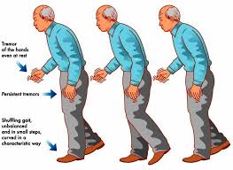 Image result for Rest Tremor