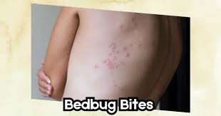 Image result for bedbugs bites
