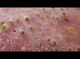 Recail islam june 12, 2017 no comments. Best Blackhead Extraction On Ear Pimple Popping Most Satisfying In The World 4 Hd 2018 Must Watch Youtube
