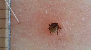 Bird Mites In Hair Pin On Healthy Lifestyle