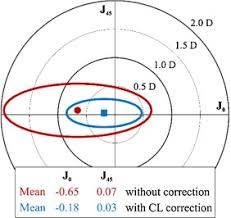 Axis Free Correction Of Astigmatism Using Bifocal Soft