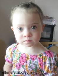 Normal modelling • optic nerve atrophy • compression of the brain stem. A Closer Look At The Physical Characteristics Of Down Syndrome Ellen Stumbo