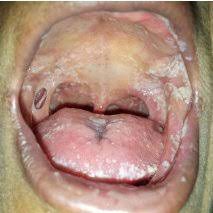 Anterior faucial pillar (or palatoglossal arch) is formed by the. Extensive Oral Candidiasis With Anterior Faucial Pillar Perforation Download Scientific Diagram