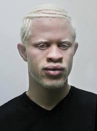 How Beautiful Is He With His Strong Features And Blond Hair Natural Hair Hair Beauty In 2020 Albinism Interesting Faces Unique Faces