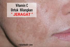 Krim hilangkan jeragat yang paling berkesan. Vitamin C Untuk Hilangkan Jeragat Rubiah Kadir