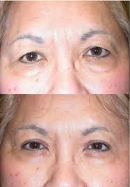Upper Eyelid Blepharoplasty
