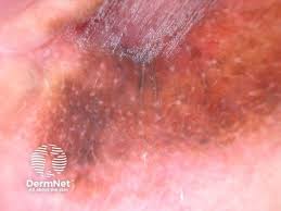 Image result for Vulvar Cancer