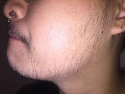 % positive response to minoxidil. My Minoxidil Journey At Beard Profile Forum