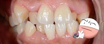 Dientes Chuecos Solucion Dental