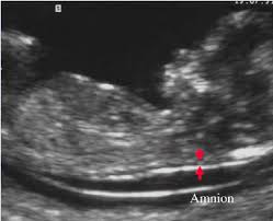 normal nuchal translucency measurement arrows at 12