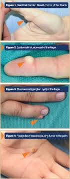 Abashed definitions what is abacaxi? Hand Wrist Tumors White Plains Ganglion Cyst New York