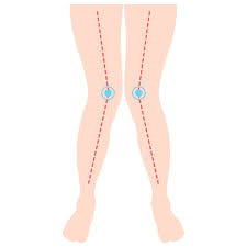 Image result for In-Toeing