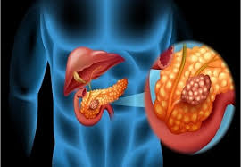 How serious pancreatic cancer is depends on where it is in the pancreas, how big it is, if it has spread, and your general health. Ù…Ø§ Ù‡ÙŠ Ø§Ù„Ø£Ø·Ø¹Ù…Ø© Ø§Ù„ØªÙŠ ÙŠØ¬Ø¨ ØªØ¬Ù†Ø¨Ù‡Ø§ Ù…Ø¹ Ø³Ø±Ø·Ø§Ù† Ø§Ù„Ø¨Ù†ÙƒØ±ÙŠØ§Ø³ Vaidam Com