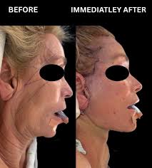 Tim Minton, MD, FACS