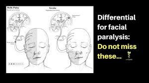 Look for a vi nerve palsy or other long tract or other cranial nerve signs which would isolate the lesion to the pons and suggest a central lesion. Approaching Facial Paralysis Youtube