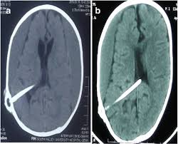 Ventriculoperitoneal Shunt Complications A Local Study At Qena University Hospital A Retrospective Study Springerlink