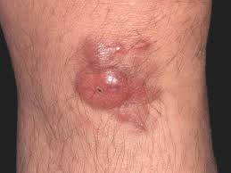 Image result for Dermatofibrosarcoma Protuberans