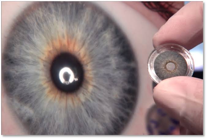 Implant d'iris de près، من إنشاء الذكاء الاصطناعي