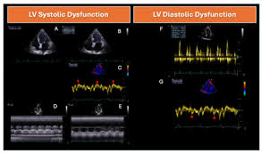 Image result for Systolic Dysfunction