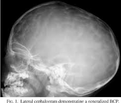 We would like to show you a description here but the site won't allow us. Early Beaten Copper Pattern Its Long Term Effect On Intelligence Quotients In 95 Children With Craniosynostosis Semantic Scholar