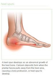 Pin On Bone Spurs Feet
