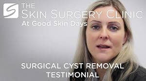Cyst Removal Testimonials at the Skin Surgery Clinic