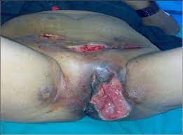 If you do, intravenous (iv) antibiotics during labor can save your baby's life. Necrotizing Fasciitis Ulcer In Suprapubic Region Right Left Iliac Download Scientific Diagram