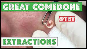 Sandra lee, the dermatologist who toplines tlc's hit unscripted series dr. Greatest Blackheads And Whiteheads Tbt Youtube