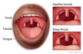 Image result for Strep throat infection roof of mouth