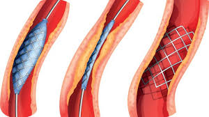 Global Stents Vasculares Análise de tendências do mercado 2020-2026 do e  Análise de Efeito de Coronavírus (COVID-19) | Jogadores-chave – Medtronic,  Abbott, Boston Scientific, BIOTRONIK, B. Braun, Terumo, STENTYS – The CMYK  Digest