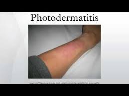 Image result for Photodermatitis