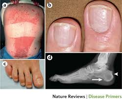 A chronic skin disease characterized by circumscribed red patches covered with white scales. Psoriasis Nature Reviews Disease Primers