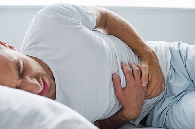 Ilustración médica del colon con enfermedad diverticular