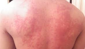 Hives (or urticaria) is a common skin reaction to individual hives can last anywhere from a few hours to a week (sometimes longer), and new ones. 3 Hives Symptoms And How To Treat Them Vujevich Dermatology