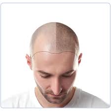 Tratamientos capilares