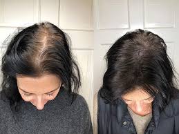 I like my body more now and have a good relationship with it. Scalp Micropigmentation Benefits Side Effects Before After Pics